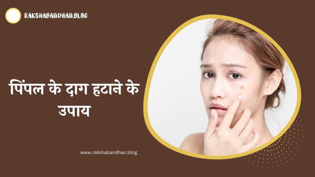 पिंपल के दाग हटाने के उपाय - Pimples Ke Daag Kaise Hataye