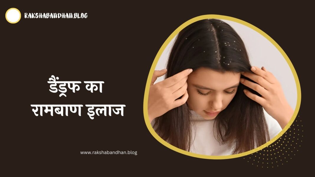 डैंड्रफ का रामबाण इलाज (1 दिन में डैंड्रफ कैसे हटाए) - Dandruff Kaise Hataye